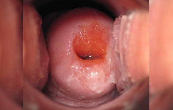 Cervix in the follicular phase