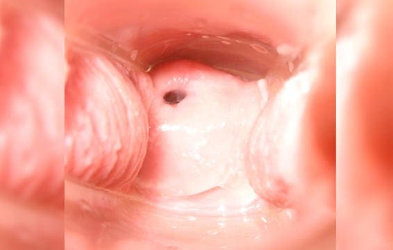 Cervix in ovulation