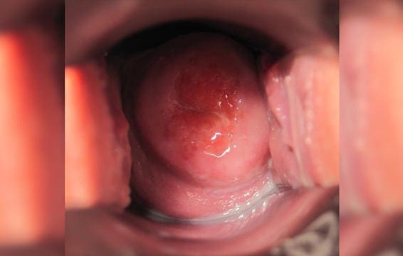 Cervix in the luteal phase 