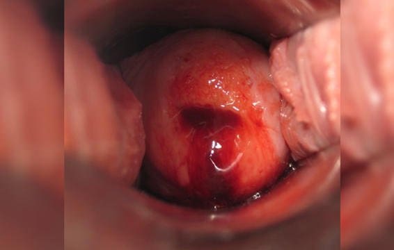 Cervix during menstruation
